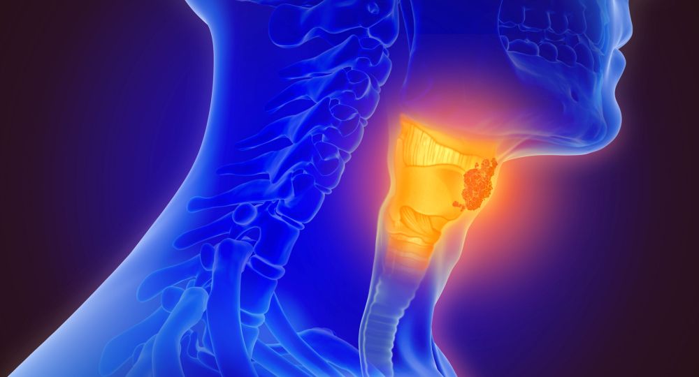 3d illustration of throat cancer